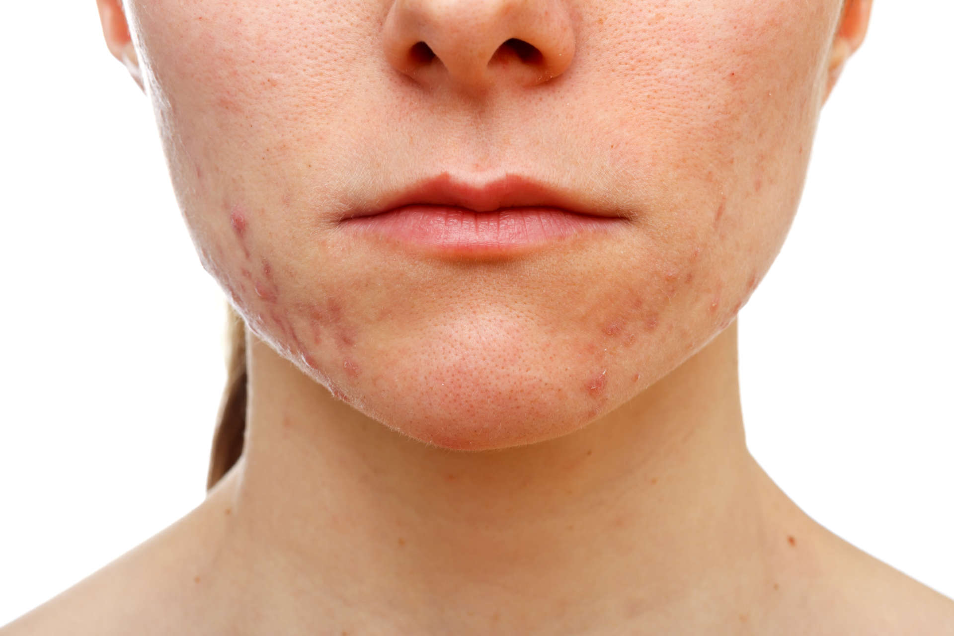 Imagem da especialidade: Cicatriz de acne